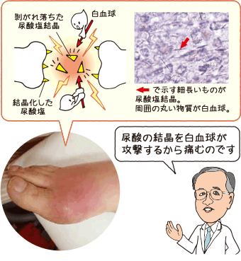 尿酸値が高いと痛風になることも｜高尿酸血症・痛風｜三和化学研究所